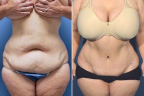 abdominoplasty-26611a-gring