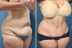 abdominoplasty-26611b-gring