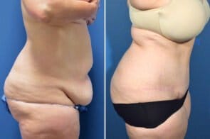 abdominoplasty-26611c-gring