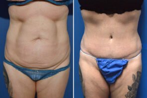 abdominoplasty-26651a-gring