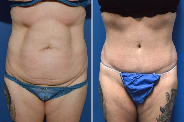 Tummy Tuck Case # 180