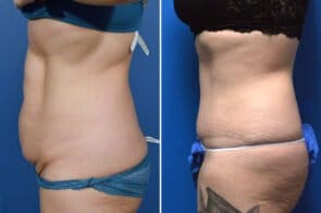 abdominoplasty-26651c-gring