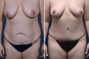 abdominoplasty-26663a-gring