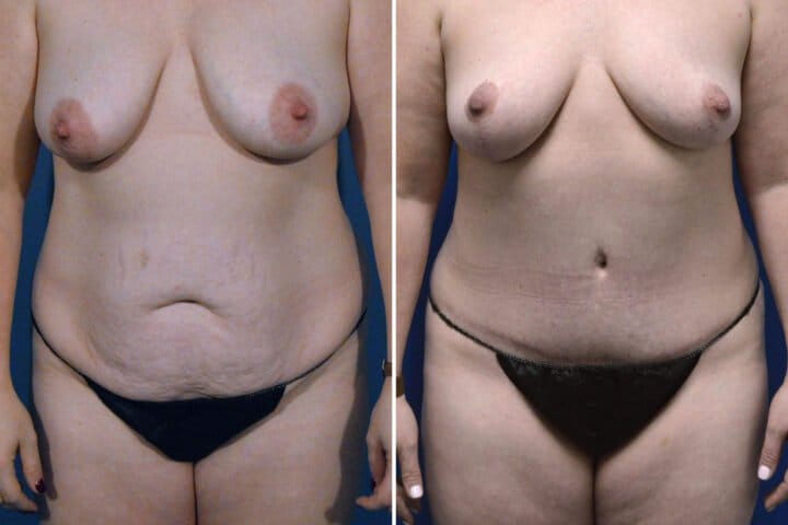 Tummy Tuck Case # 185