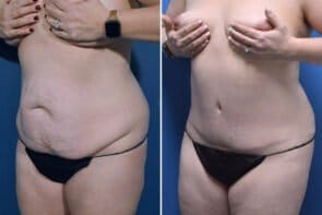 abdominoplasty-26663b-gring