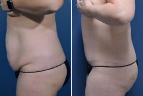 abdominoplasty-26663c-gring