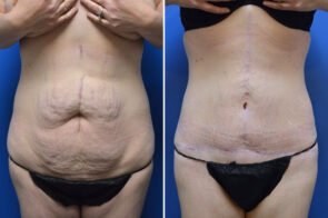 abdominoplasty-26695-3a-gring