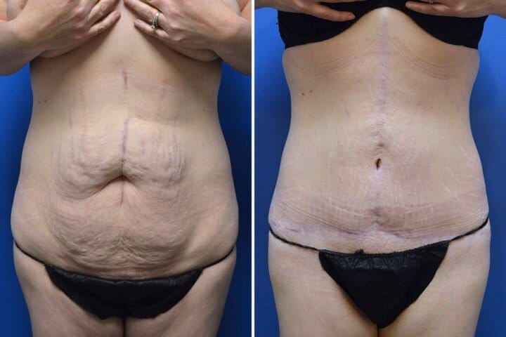 Tummy Tuck Case # 190