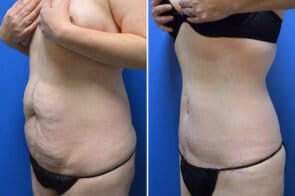 abdominoplasty-26695-3b-gring