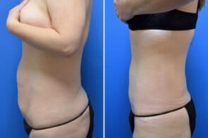 abdominoplasty-26695-3c-gring