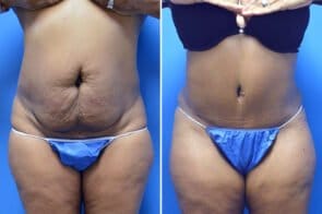 Tummy Tuck Case # 195