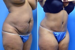 abdominoplasty-26728b-gring