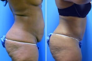 abdominoplasty-26728c-gring