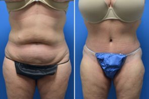 abdominoplasty-26736a-gring