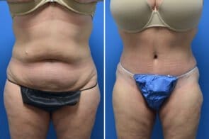 Tummy Tuck Case # 205