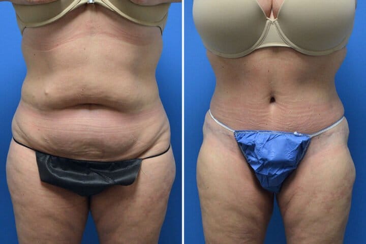 Tummy Tuck Case # 205