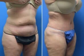 abdominoplasty-26736b-gring