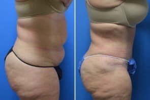 abdominoplasty-26736c-gring