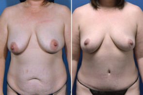 abdominoplasty-breast-lift-26663a-gring