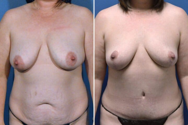 Breast Lift case #160