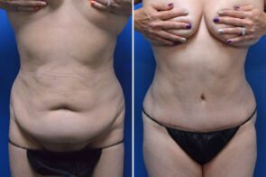 abdominoplasty-liposuction-26639a-gring