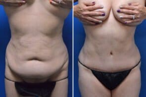 Tummy Tuck Case # 175