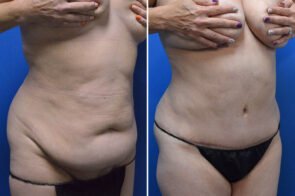 abdominoplasty-liposuction-26639b-gring
