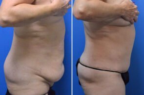 abdominoplasty-liposuction-26639c-gring
