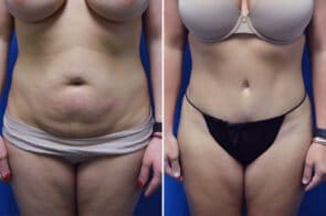 abdominoplastyc-26625a-gring