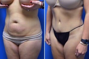 abdominoplastyc-26625b-gring