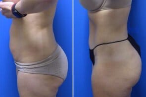 abdominoplastyc-26625c-gring