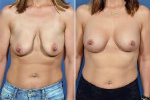 breast-augmentation-lift-26656a-gring