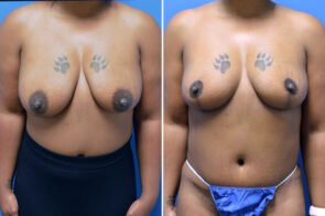 Breast Lift Case # 150