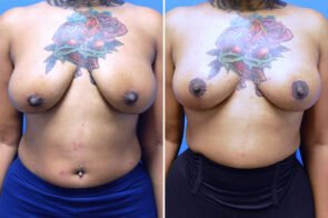 breast-lift-26618a-gring