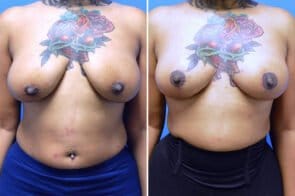 breast-lift-26618a-gring