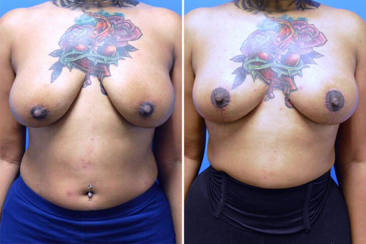 Breast Lift Case # 155
