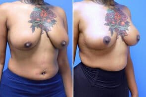 breast-lift-26618b-gring