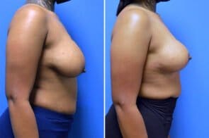 breast-lift-26618c-gring