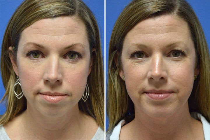 Chin Enlargement Case # 100