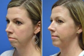 chin-enlargement-26702b-gring