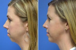 chin-enlargement-26702c-gring
