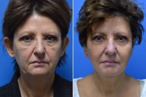 Facelift and Ear Surgery Case # 150