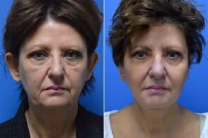 facelift-otoplasty-26684a-gring