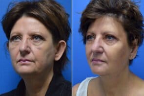 facelift-otoplasty-26684b-gring