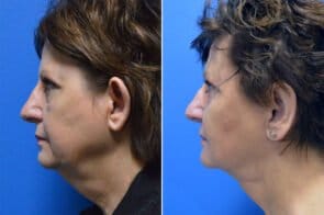 facelift-otoplasty-26684c-gring