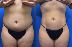 Liposuction Case # 140