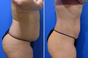 liposuction-26632c-gring