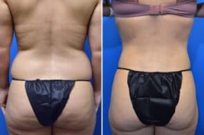 liposuction-26632d-gring