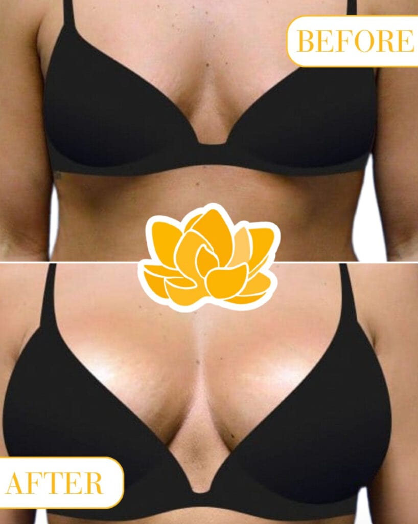 Little Rock Cosmetic Surgery Center Breast Augmentation before and after results