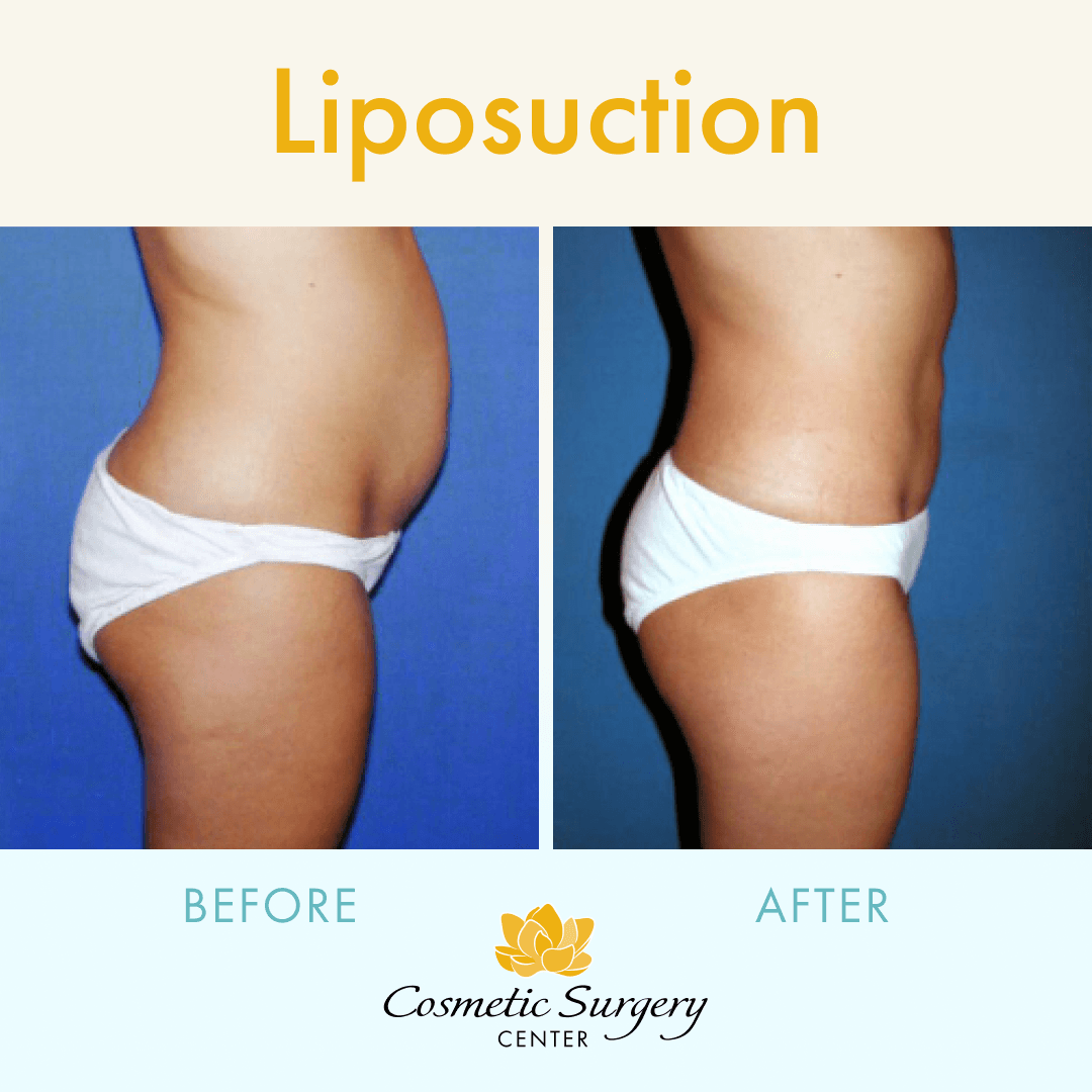 Little Rock Cosmetic Surgery Center liposuction before and after resuts